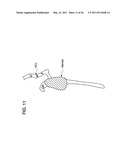 METHODS FOR LESS INVASIVE GLENOID REPLACEMENT diagram and image