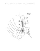 JOINT PROSTHESIS diagram and image