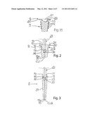 JOINT PROSTHESIS diagram and image