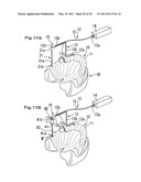 SURGICAL GUIDE, AND A METHOD FOR POSITIONING A DRILL USING THE SURGICAL GUIDE diagram and image