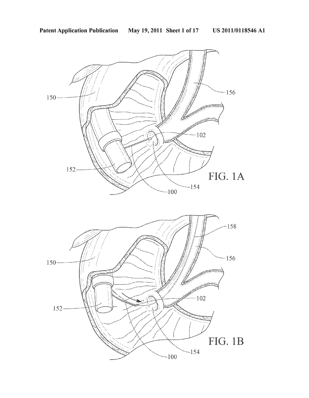 BALLOON CATHETER WITH DETACHABLE HUB, AND METHODS FOR SAME - diagram, schematic, and image 02