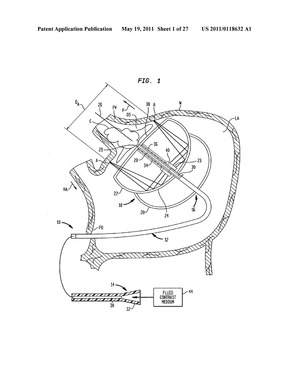 CARDIAC ABLATION DEVICES - diagram, schematic, and image 02