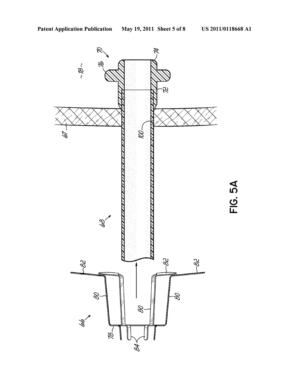 CANNULA STABILIZER - diagram, schematic, and image 06