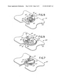 CATHETER SECUREMENT DEVICE diagram and image