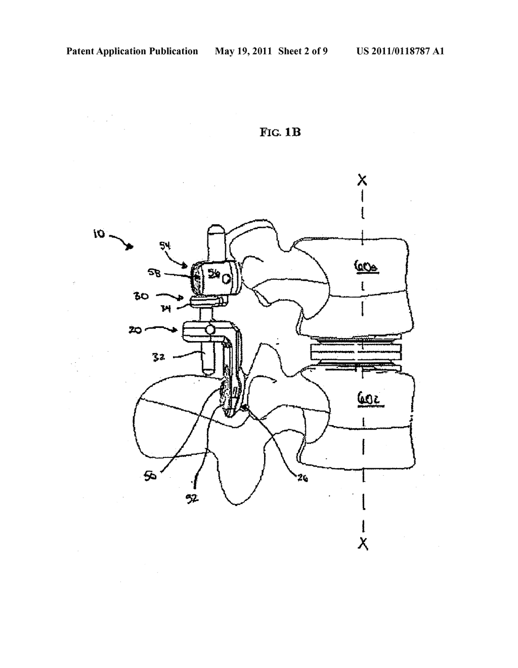 ARTIFICIAL FACET JOINT - diagram, schematic, and image 03