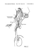 SYSTEMS AND METHODS FOR IMPLANTABLE LEADLESS NERVE STIMULATION diagram and image