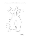 Stent Graft and Introducer Assembly diagram and image