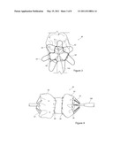 Stent Graft and Introducer Assembly diagram and image