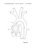 Stent Graft and Introducer Assembly diagram and image