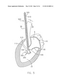 System For Replacing Native Valve Function Of A Diseased Aortic Valve diagram and image