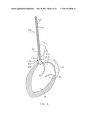 System For Replacing Native Valve Function Of A Diseased Aortic Valve diagram and image