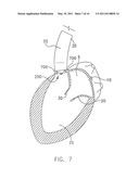 System For Replacing Native Valve Function Of A Diseased Aortic Valve diagram and image