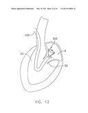 System For Replacing Native Valve Function Of A Diseased Aortic Valve diagram and image