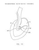 System For Replacing Native Valve Function Of A Diseased Aortic Valve diagram and image