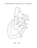 System For Replacing Native Valve Function Of A Diseased Aortic Valve diagram and image