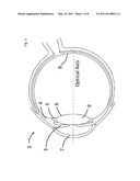 FLUIDIC INTRAOCULAR LENS SYSTEMS AND METHODS diagram and image