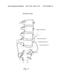 APPARATUS, SYSTEMS, AND METHODS FOR ACHIEVING TRANS-ILIAC LUMBAR FUSION diagram and image