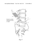 APPARATUS, SYSTEMS, AND METHODS FOR ACHIEVING TRANS-ILIAC LUMBAR FUSION diagram and image