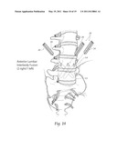 APPARATUS, SYSTEMS, AND METHODS FOR ACHIEVING TRANS-ILIAC LUMBAR FUSION diagram and image