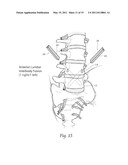 APPARATUS, SYSTEMS, AND METHODS FOR ACHIEVING TRANS-ILIAC LUMBAR FUSION diagram and image