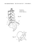 APPARATUS, SYSTEMS, AND METHODS FOR ACHIEVING TRANS-ILIAC LUMBAR FUSION diagram and image
