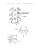 APPARATUS, SYSTEMS, AND METHODS FOR ACHIEVING TRANS-ILIAC LUMBAR FUSION diagram and image