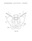 APPARATUS, SYSTEMS, AND METHODS FOR ACHIEVING TRANS-ILIAC LUMBAR FUSION diagram and image