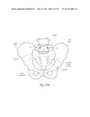 APPARATUS, SYSTEMS, AND METHODS FOR ACHIEVING TRANS-ILIAC LUMBAR FUSION diagram and image