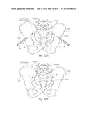 APPARATUS, SYSTEMS, AND METHODS FOR ACHIEVING TRANS-ILIAC LUMBAR FUSION diagram and image