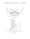 APPARATUS, SYSTEMS, AND METHODS FOR ACHIEVING TRANS-ILIAC LUMBAR FUSION diagram and image