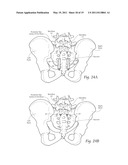 APPARATUS, SYSTEMS, AND METHODS FOR ACHIEVING TRANS-ILIAC LUMBAR FUSION diagram and image