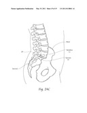 APPARATUS, SYSTEMS, AND METHODS FOR ACHIEVING TRANS-ILIAC LUMBAR FUSION diagram and image