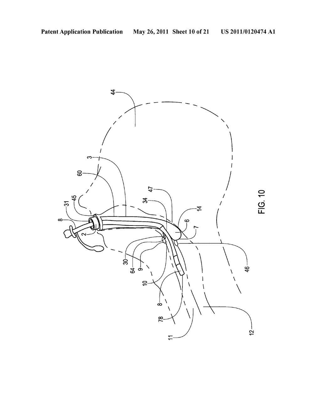 AIRWAY DEVICES, TUBE SECURING DEVICES, AND METHODS OF MAKING AND USING THE SAME - diagram, schematic, and image 11