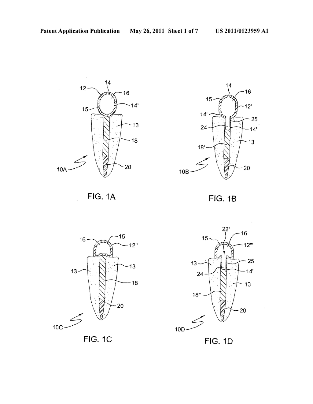 Force redirecting dental core system - diagram, schematic, and image 02