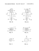 Force redirecting dental core system diagram and image