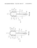 Force redirecting dental core system diagram and image