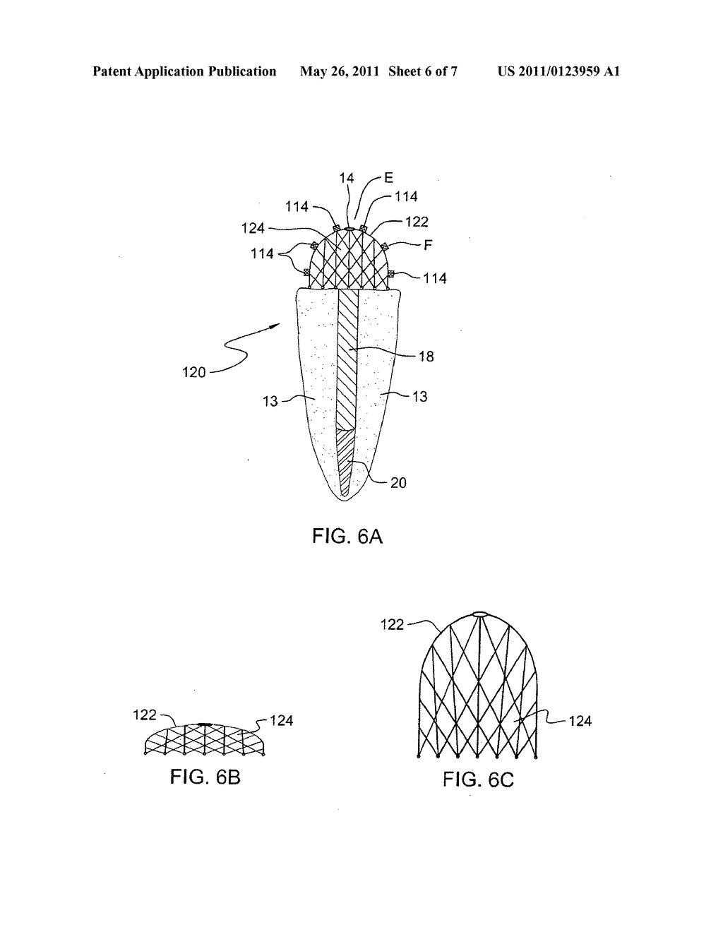 Force redirecting dental core system - diagram, schematic, and image 07