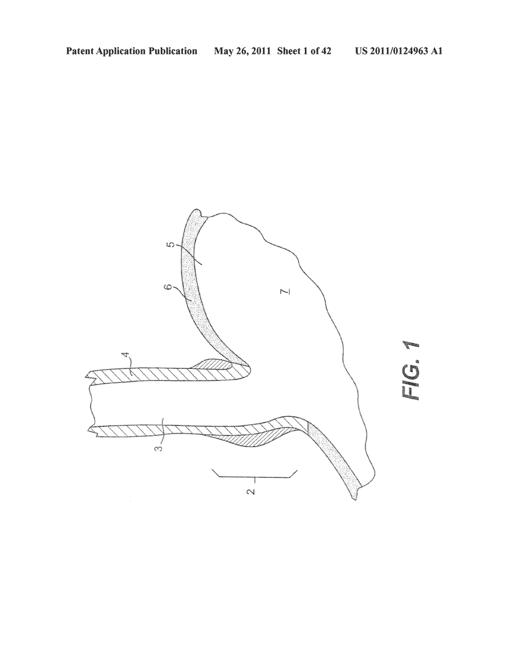 DEVICES AND METHODS FOR FASTENING TISSUE LAYERS - diagram, schematic, and image 02