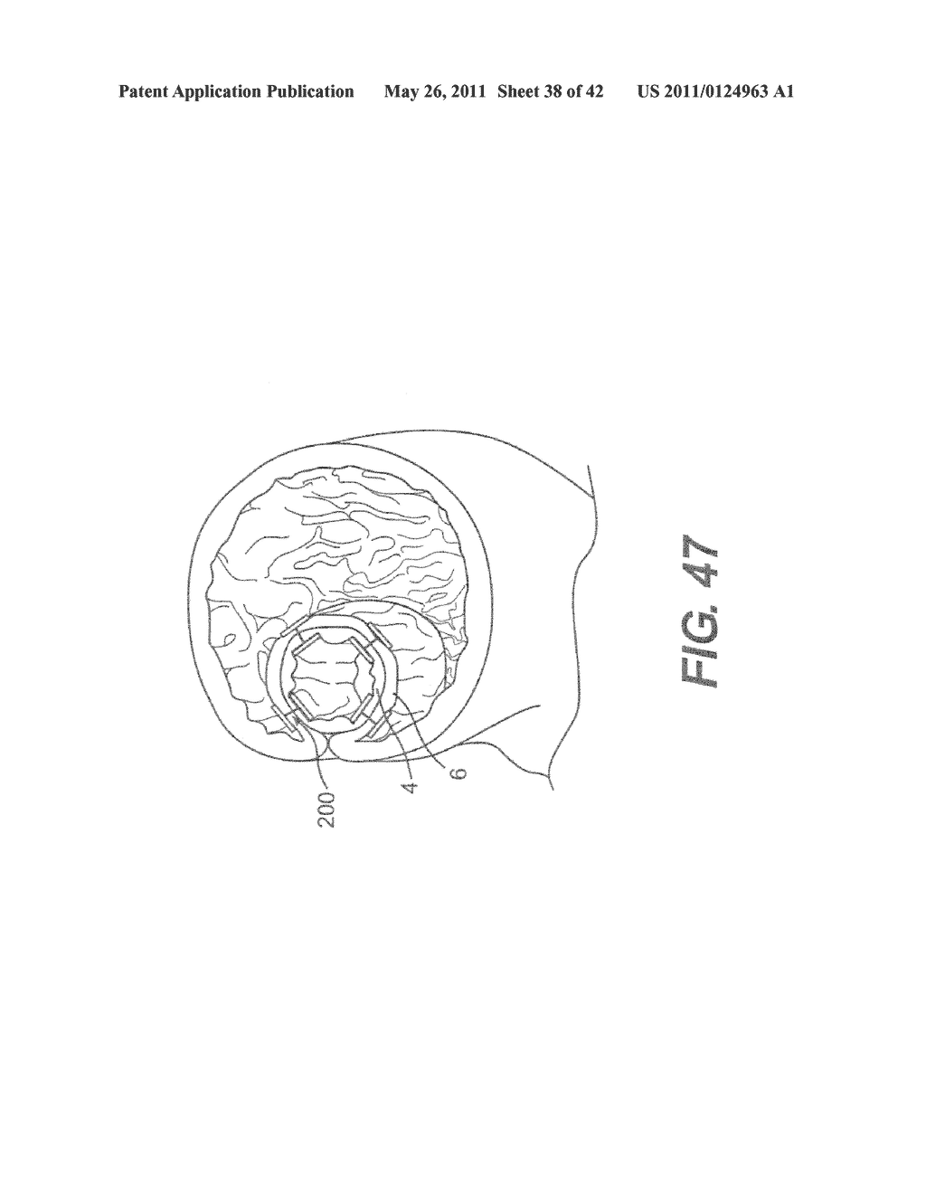 DEVICES AND METHODS FOR FASTENING TISSUE LAYERS - diagram, schematic, and image 39