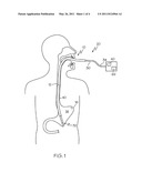 METHODS FOR CLOSING A GASTROTOMY diagram and image