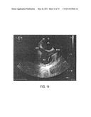 Pharyngeal Ultrasound Guide diagram and image