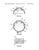 OPHTHALMIC DRUG DELIVERY SYSTEM AND METHOD diagram and image