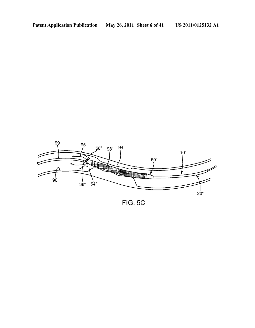 APPARATUS AND METHODS FOR TREATING OBSTRUCTIONS WITHIN BODY LUMENS - diagram, schematic, and image 07