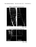 Cryotherapy Methods for Treating Vessel Dissections and Side Branch Occlusion diagram and image