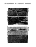 Cryotherapy Methods for Treating Vessel Dissections and Side Branch Occlusion diagram and image