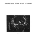 METHOD FOR TREATING JOINT PAIN AND ASSOCIATED INSTRUMENTS diagram and image