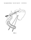 METHOD FOR TREATING JOINT PAIN AND ASSOCIATED INSTRUMENTS diagram and image