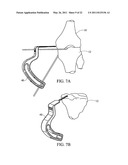 METHOD FOR TREATING JOINT PAIN AND ASSOCIATED INSTRUMENTS diagram and image