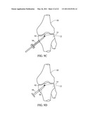 METHOD FOR TREATING JOINT PAIN AND ASSOCIATED INSTRUMENTS diagram and image