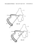 METHOD FOR TREATING JOINT PAIN AND ASSOCIATED INSTRUMENTS diagram and image